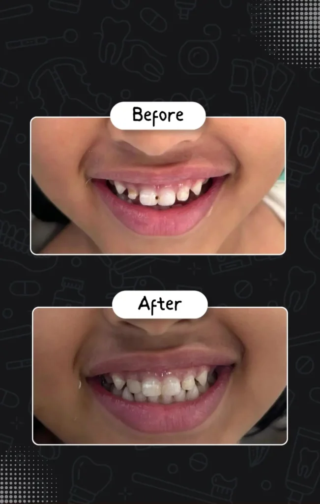 Before and after video of a child's front baby tooth cavity treatment at Nihaan's Dental Clinic, Hyderabad.