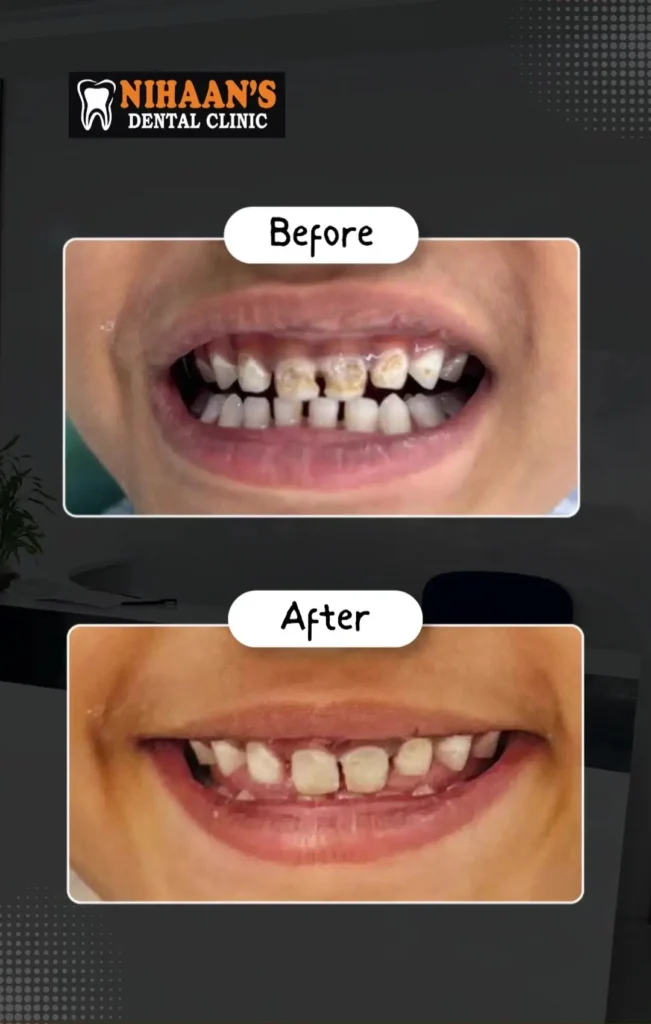 Before and after video of multiple front tooth cavities treated at Nihaan's Dental Clinic, Hyderabad.