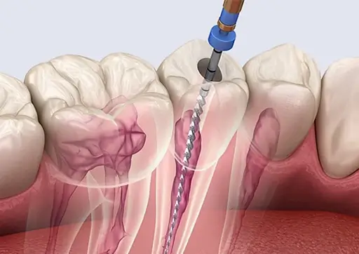 Modern Endodontic Instruments