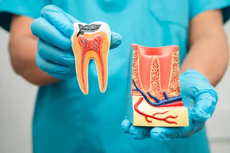 What Happens If You Delay Root Canal Treatment?